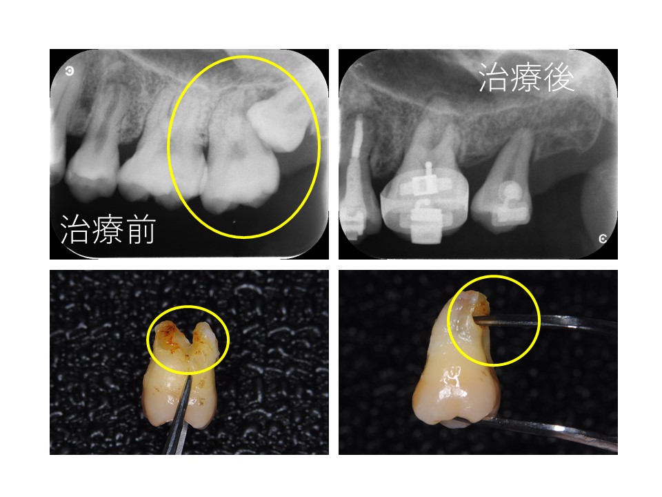 ８による７歯根吸収.jpg