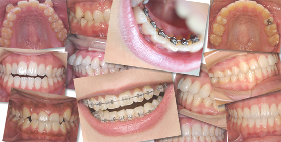 ファミリア歯科矯正の症例