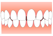 空隙歯列