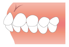 上下顎前突