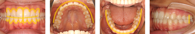 キレイな歯並びの例