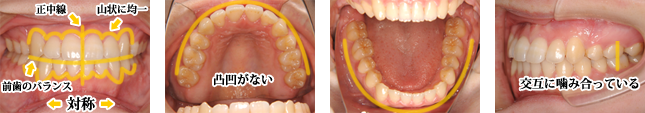 キレイな歯並びの例