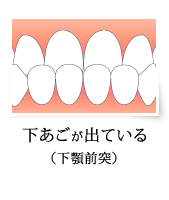 下あごが出ている（下顎前突）