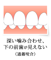 深い噛み合わせ、下の前歯が見えない（過蓋咬合）