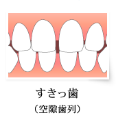 すきっ歯（空隙歯列）