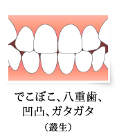 でこぼこ、八重歯、凹凸、ガタガタ（叢生）