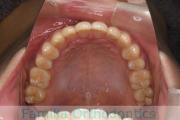 上顎