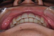 前歯の関係など